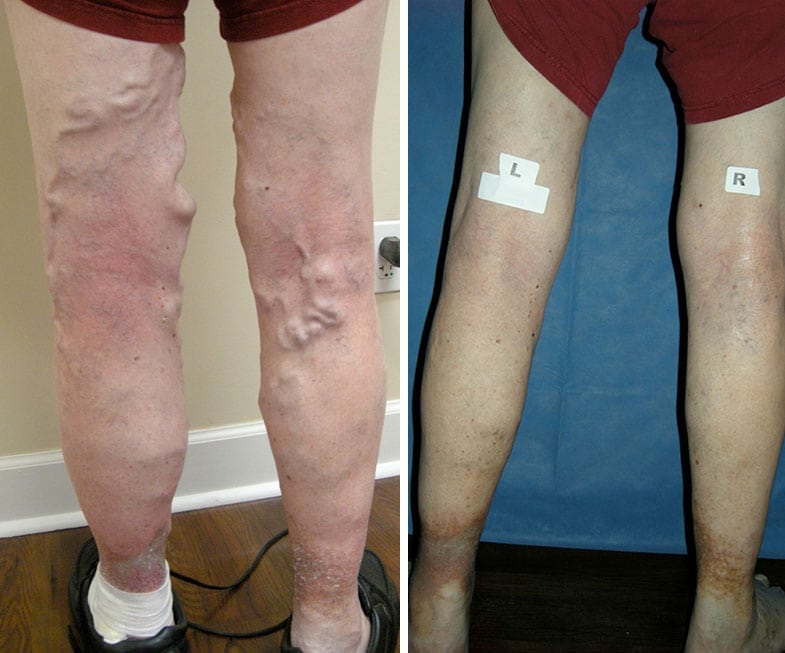 Effective and Affordable Jacksonville Vein Treatment ...