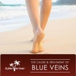 The Cause and Treatment of Blue Veins in Jacksonville