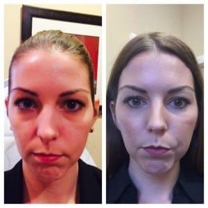 Voluma Before and After on Actual SJVC Employee