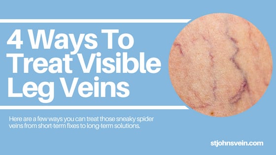 4 Ways To Treat Visible Leg Veins
