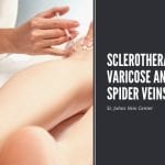 Sclerotherapy for Varicose Veins and Spider Veins