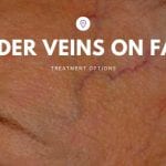 Spider Veins On Face Treatment