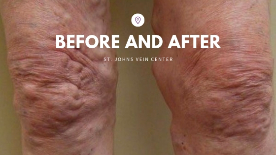 vein treatment before and after photos