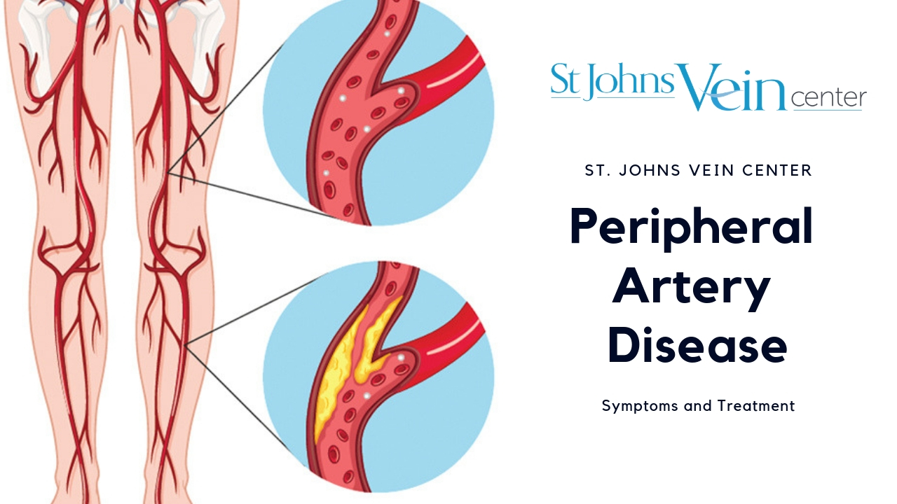 peripheral artery disease