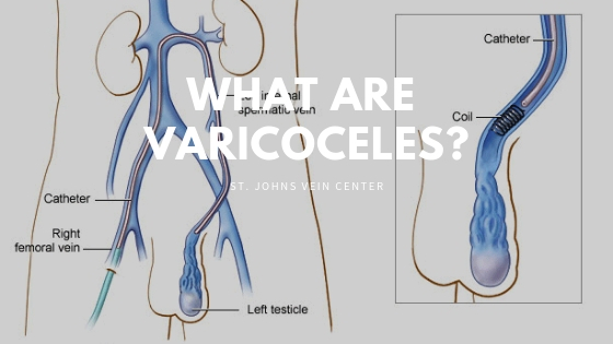 what are varicoceles