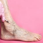 How sclerotherapy Works