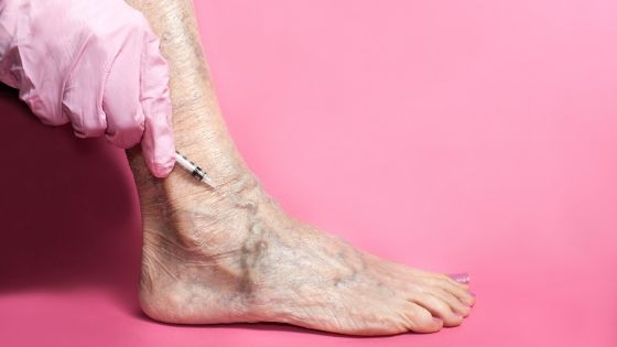 how sclerotherapy works