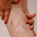 Varicose Vein Myths You Need To Know