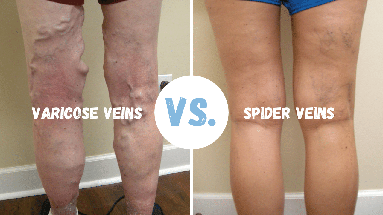 varicose and spider veins