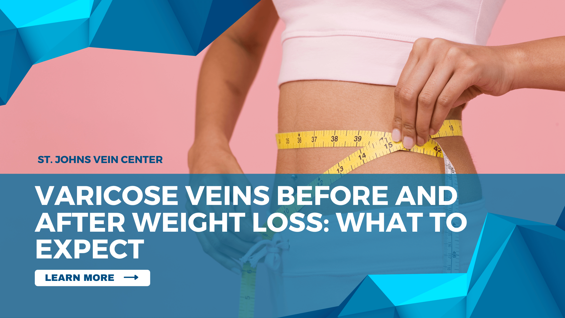 Varicose Veins Before and After Weight Loss