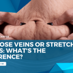 Varicose Veins Or Stretch Marks: What’s The Difference?