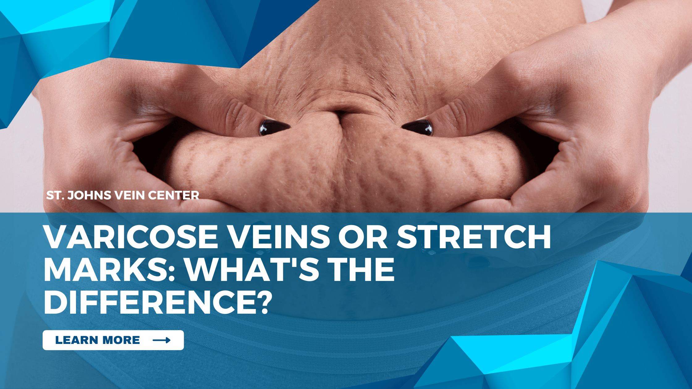Varicose Veins Or Stretch Marks