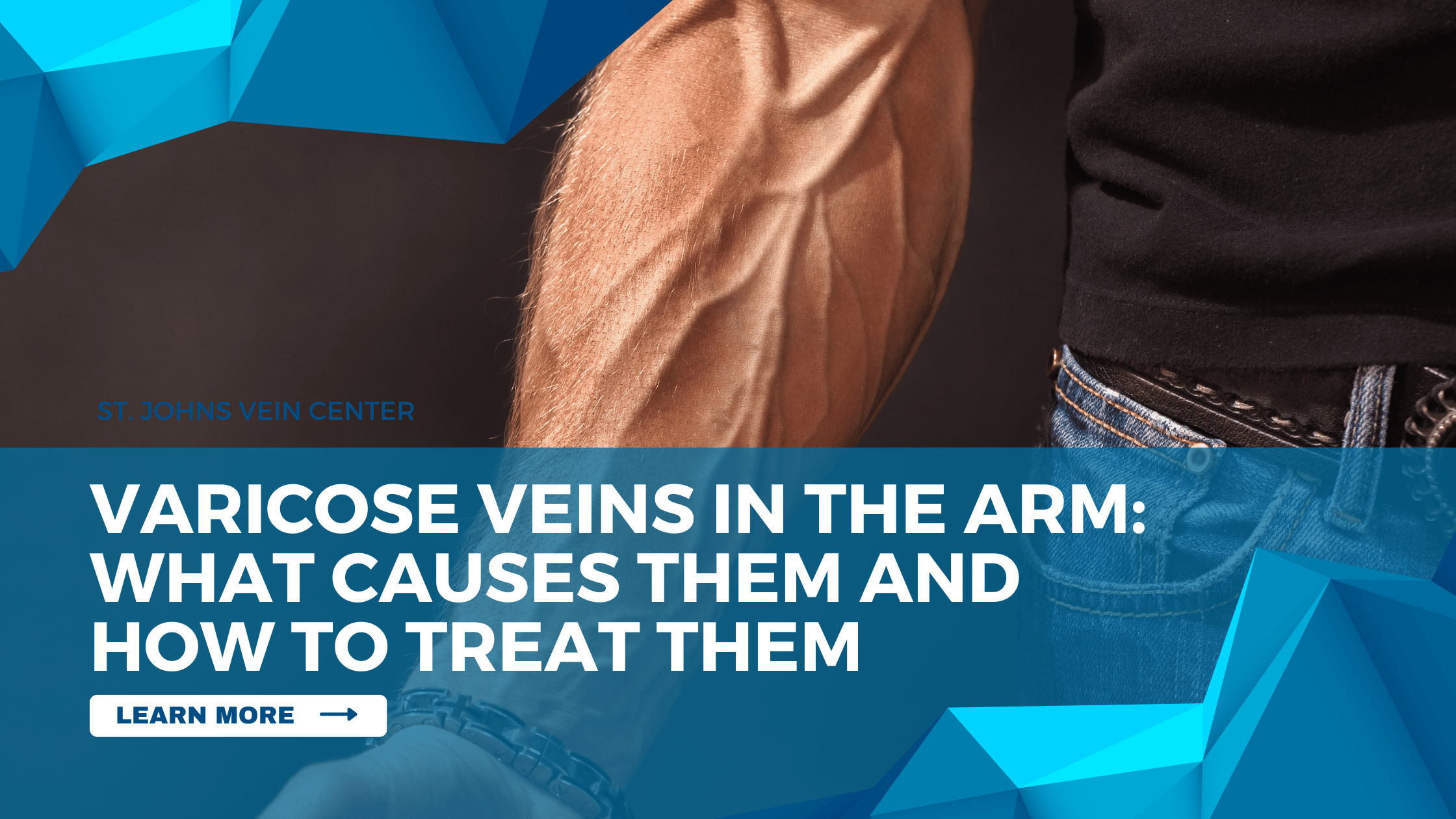 Varicose Veins In The Arm What Causes Them And How To Treat Them