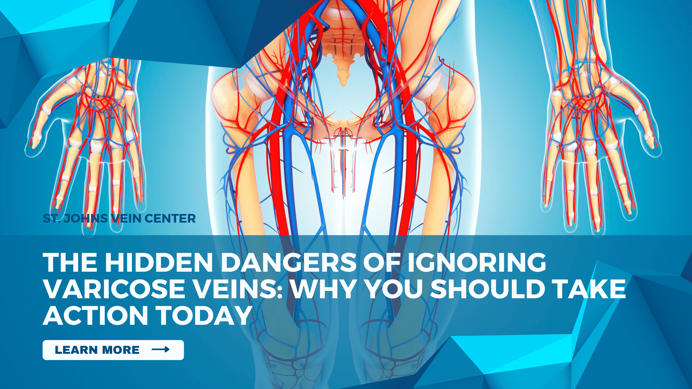 The Hidden Dangers of Ignoring Varicose Veins Why You Should Take Action Today