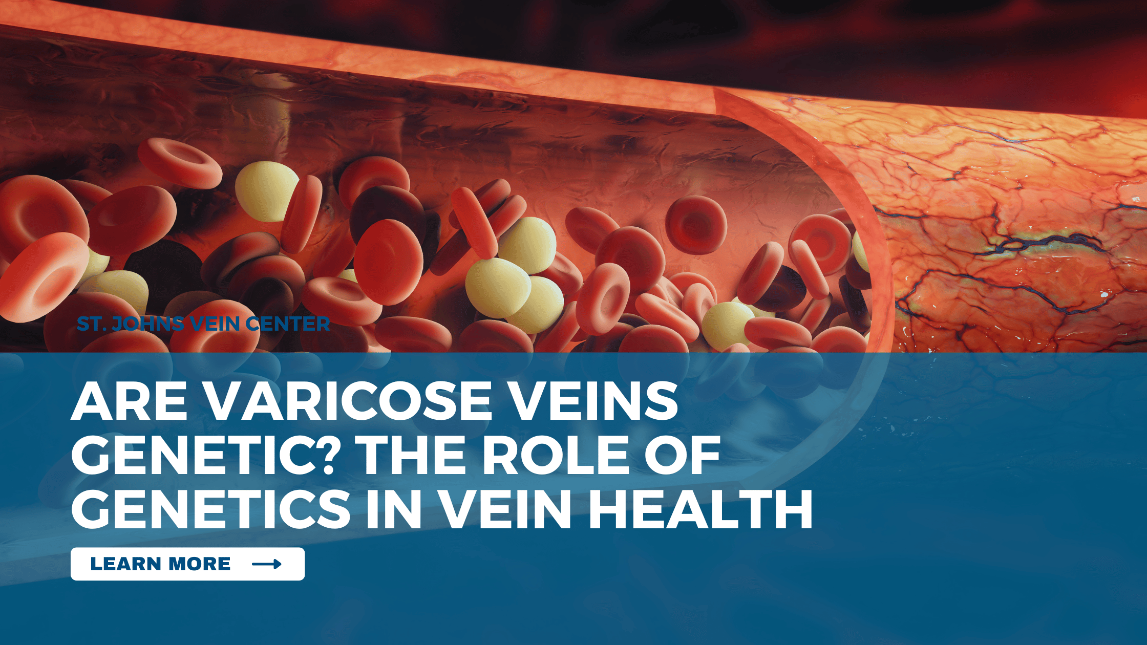 Are Varicose Veins Genetic The Role of Genetics in Vein Health