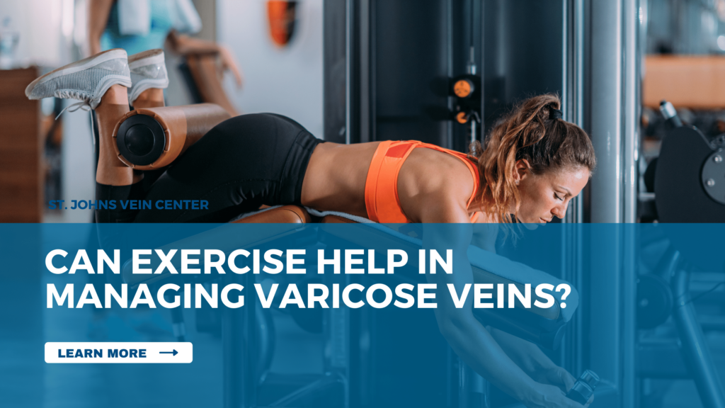 Can Exercise Help in Managing Varicose Veins